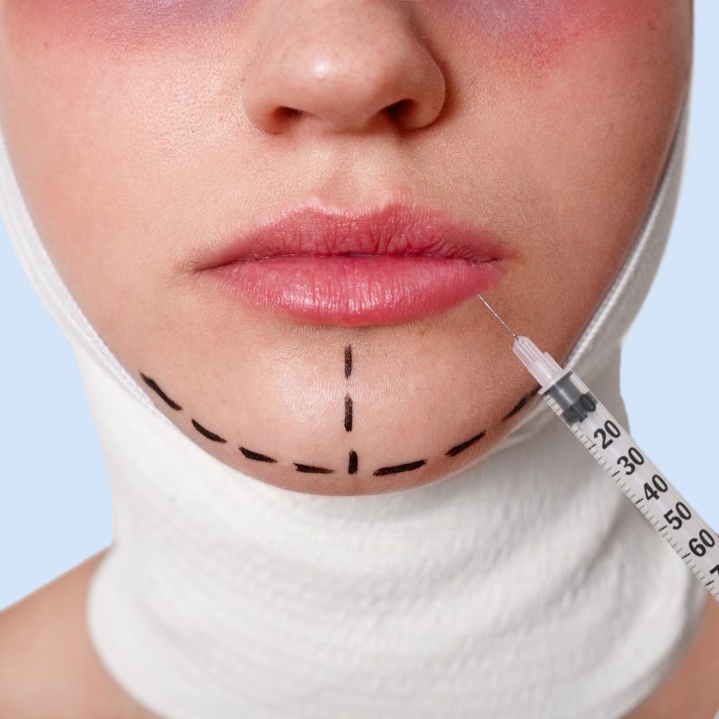 Half of face of beautiful young caucasian woman with perforation lines on chin before plastic surgery operation. Beautician holds syringe with injection, making procedures for improvement appearance.